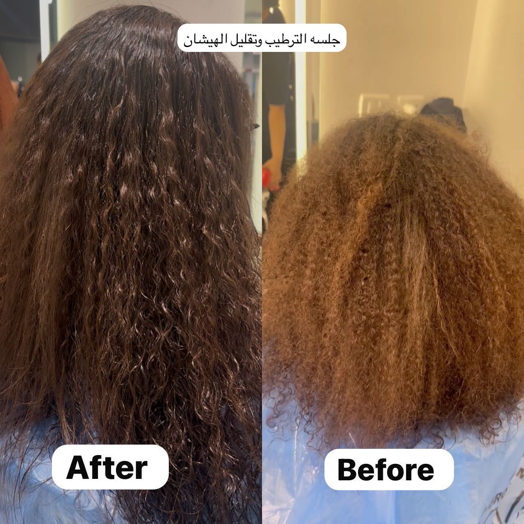 علاج ليزا الهندي
